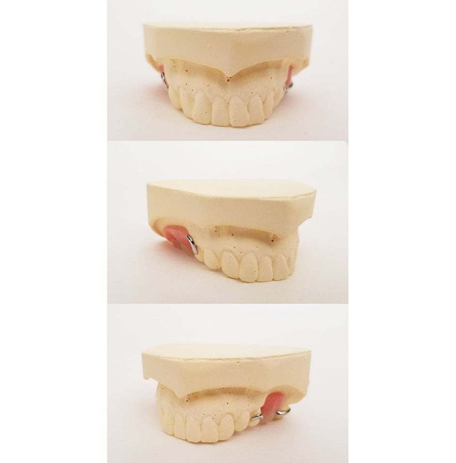 Custom Metal Partial Denture