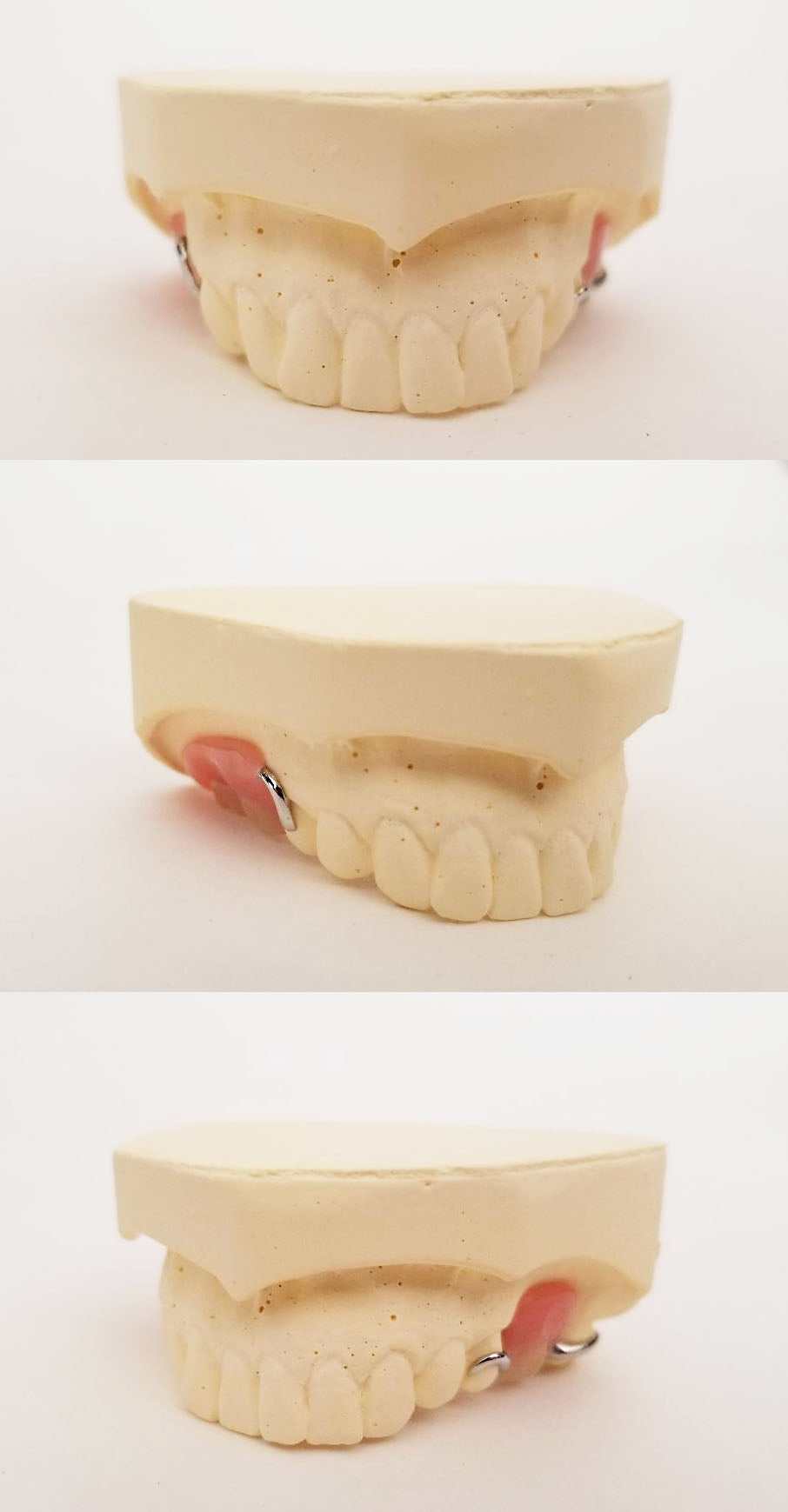 Custom Metal Partial Denture