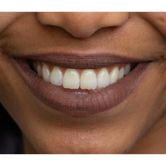 Darker Gum Color Denture Add-On
